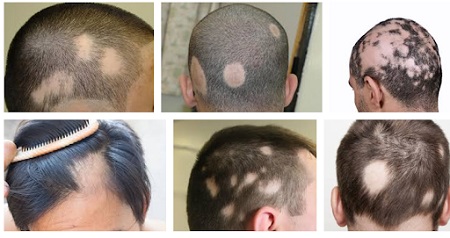 علت ریزش مو, عوامل ریزش مو, راههای جلوگیری از ریزش مو