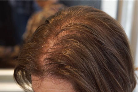 دلیل ریزش موها بعد از رنگ زدن, علت ریزش مو بعد از رنگ زدن, رنگ مو و ریزش مو
