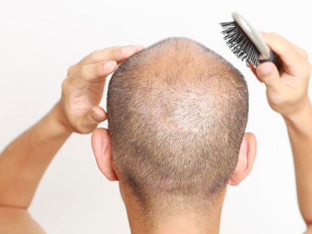جایگزین کاشت مو,روش های جایگزین کاشت مو,جایگزین کاشت مو وجود دارد