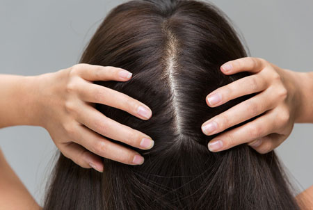 پیوند مو, پیوند مو در خانم ها,کاشت موی طبیعی یا پیوند مو در خانم‌ها
