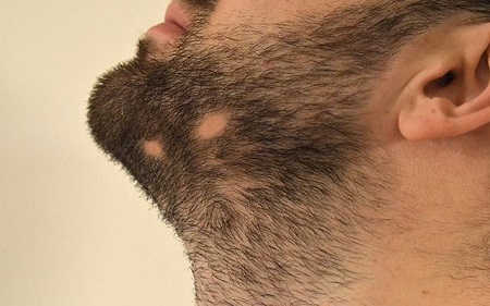 علت ریزش ریش و سبیل, درمان ریزش ریش و سبیل در آقایان, کاشت مو ریش و سبیل