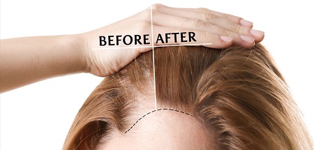 درمان ریزش مو در خانمها, کاشت مو خانم ها, انواع ریزش مو در خانم ها